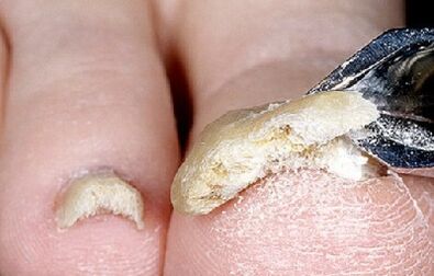 advanced stage of fungal nail infection