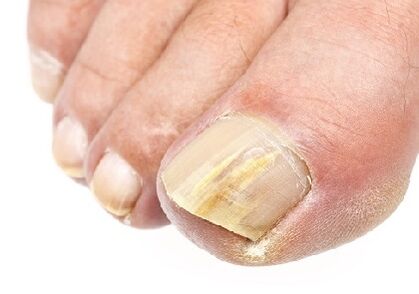 the initial stage of fungal nail infection