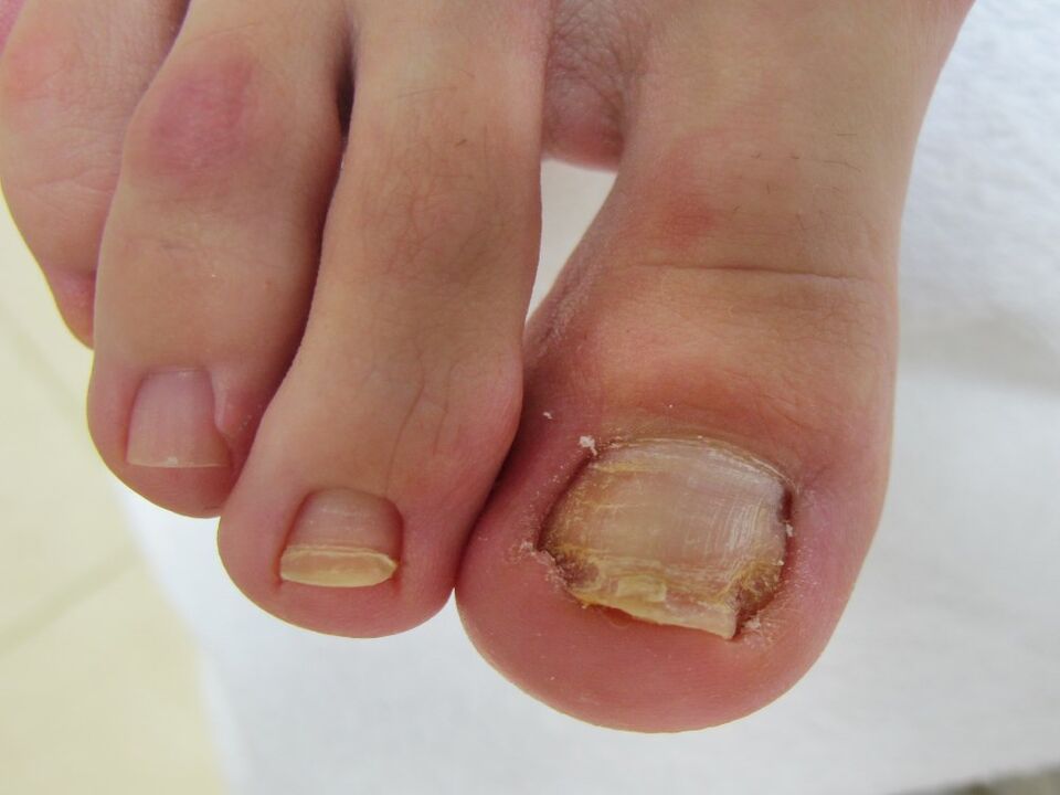 Symptoms of toenail fungus