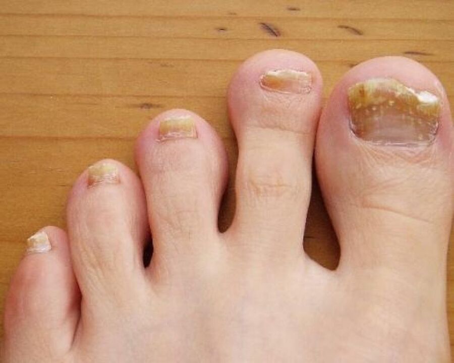 Yellowing of the nail plate due to fungal infection