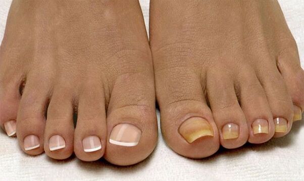 Healthy toenails (left) and fungus-infested (right)