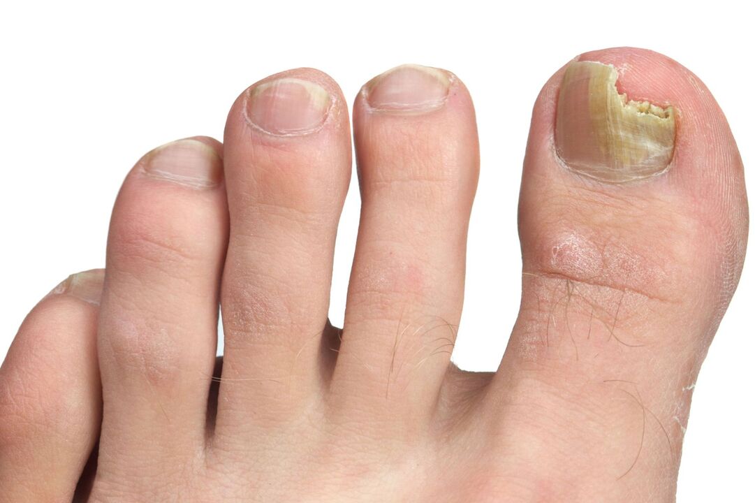 symptoms nail fungus