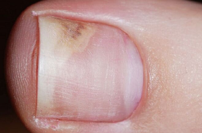 Signs of onychomycosis in the initial stages - lack of shine, a gap between the nail and the nail bed