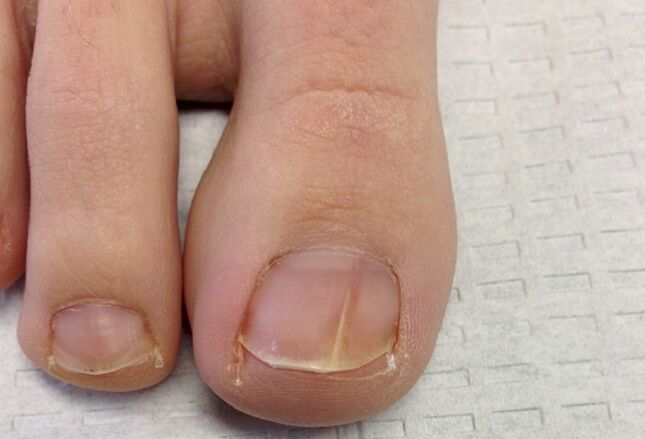 Visual manifestations of toenail fungus in the initial stages