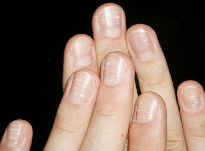 White spots on fingernails are a sign of the development of a fungus