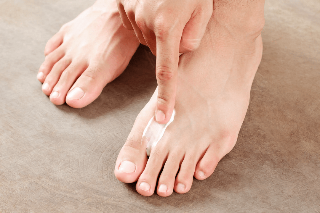 Applying an antifungal ointment to the skin of the foot