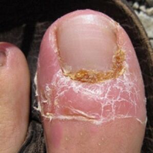 Nail fungus