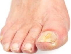 After the bathroom, the affected nail is easier to remove