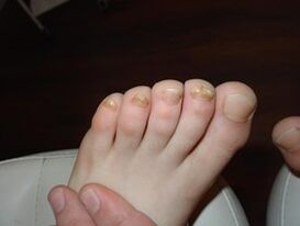 Nail fungus also happens in children