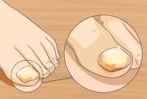 Nail fungus
