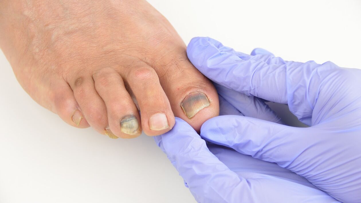 Inspection of the foot mushroom of the foot