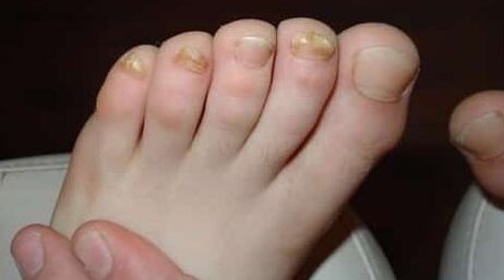 Almost all fingers are affected by the mushroom