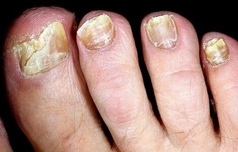 Nails crumble out of the mushroom