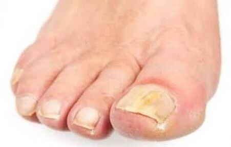 The initial phase of the mushroom on the footnail of the foot