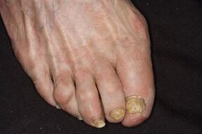 Treatment of nail fungus on the legs apple cider vinegar