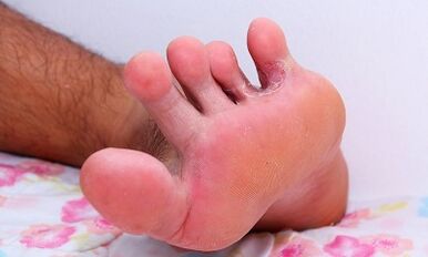The causes of the mushroom between the toes