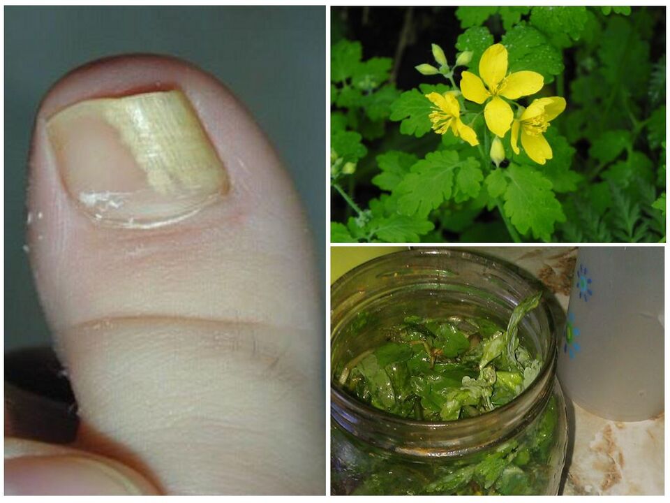 Celandine against nail fungus