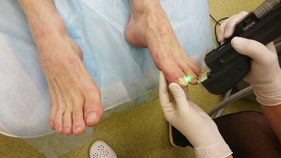 Laser therapy for nail fungus