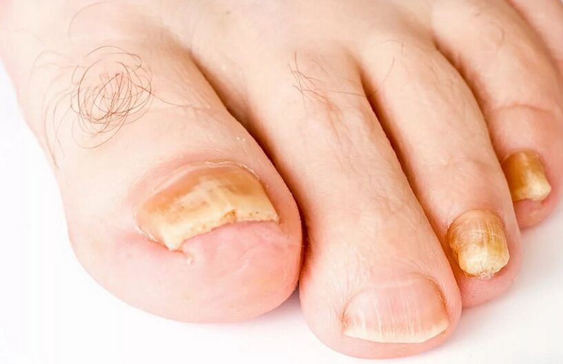 Toenail fungus