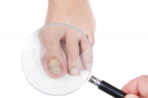 Stages and stages of development of fungus on toenails