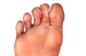 Fungus between fingers