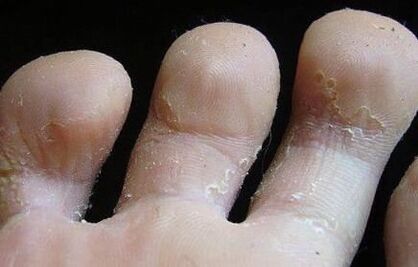 Signs of fungus between fingers