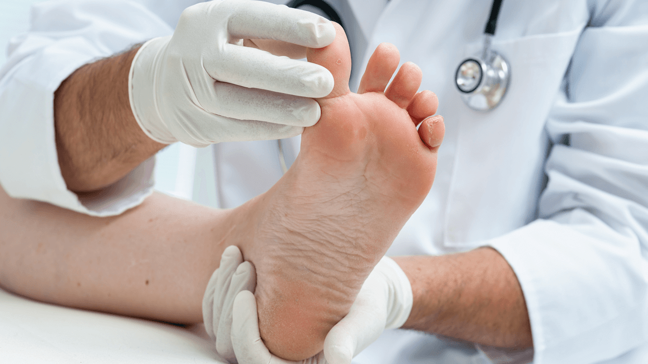 Diagnosis of athlete's foot