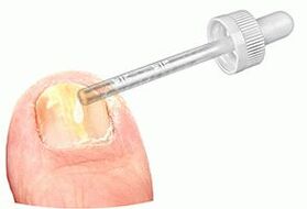 Applying medicinal drops to a nail affected by fungus