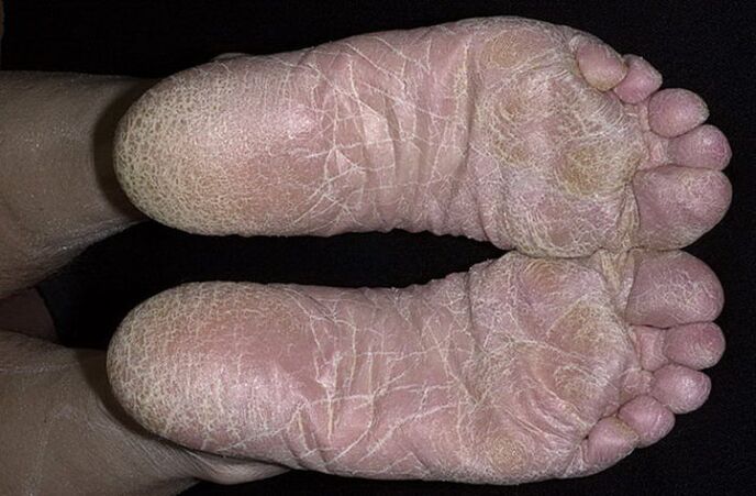 Athlete's foot