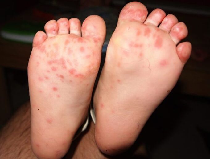Bladder fungus on the legs