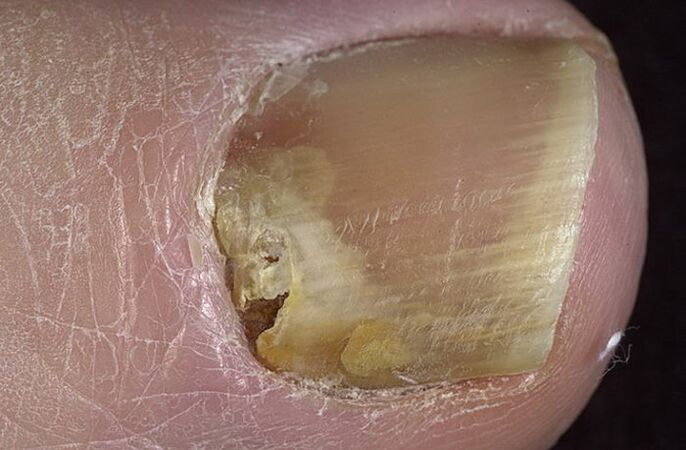 Fungus on toenails