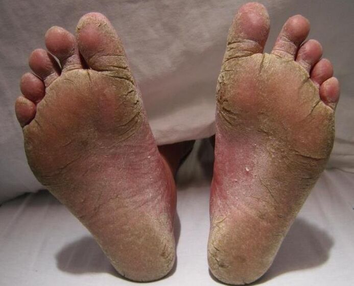 Squamous hyperkeratic fungus on the legs