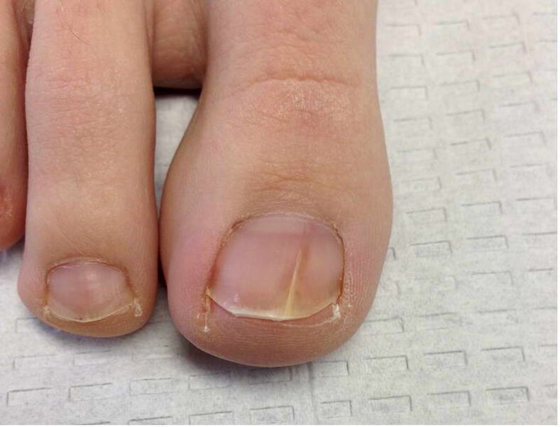 Streaks and spots on the big toenail in the first stage of fungal development