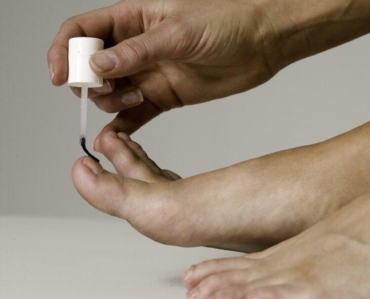 The use of medical varnish for the treatment and prevention of onychomycosis of the big toe