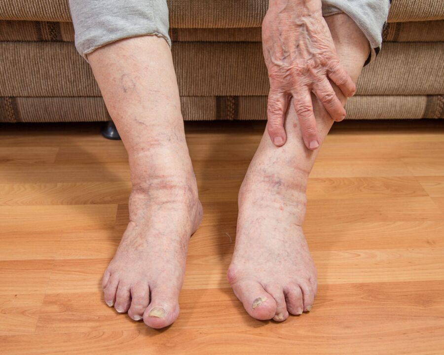 To avoid the spread of fungal microspores, you should not walk barefoot at home.